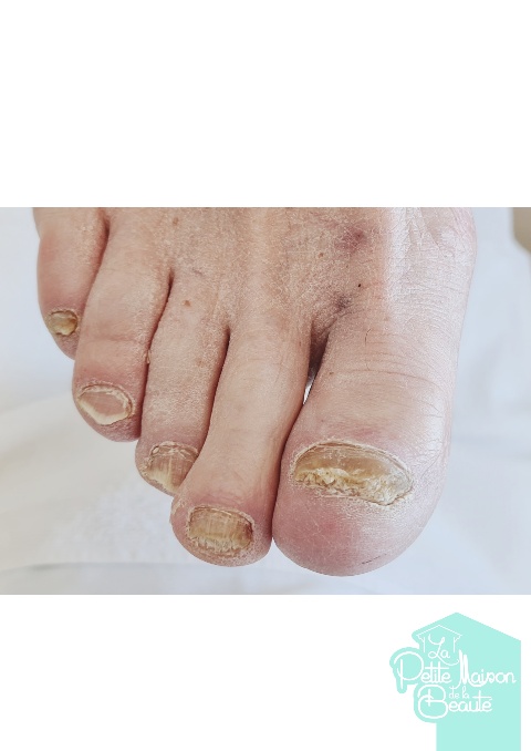 Soin des Ongles des Pieds