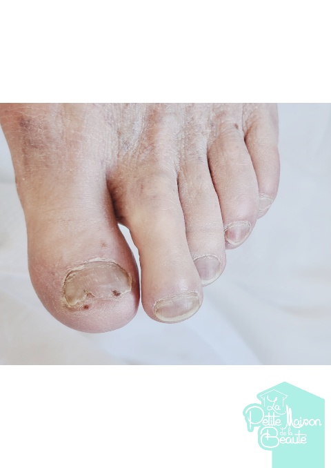 Soin des Ongles des Pieds