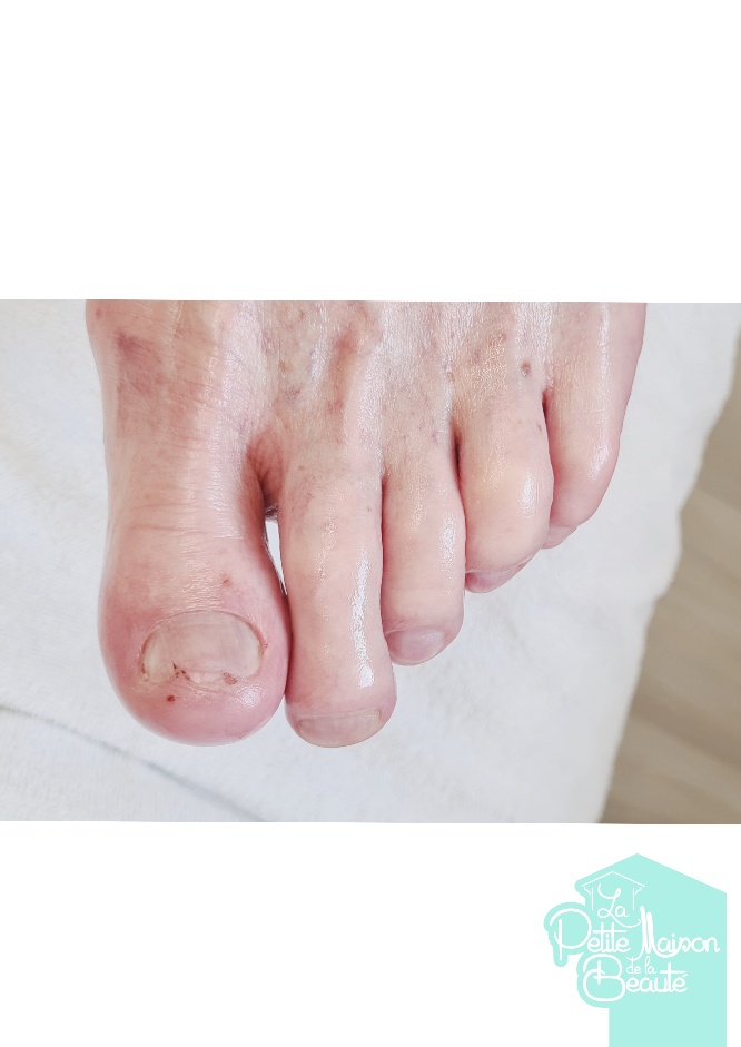 Soin des Ongles des Pieds