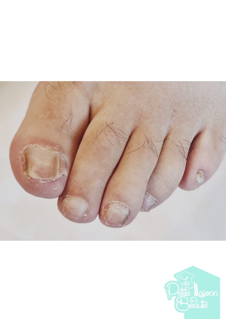 Soin des Ongles des Pieds