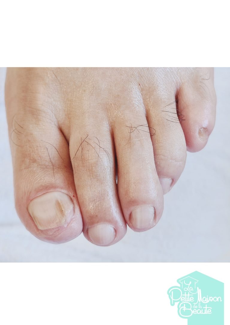 Soin des Ongles des Pieds