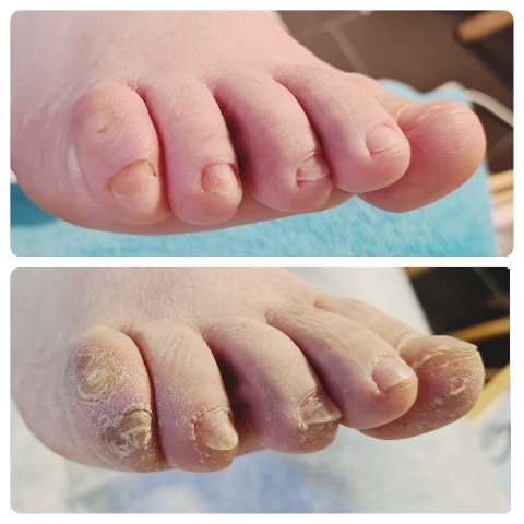 Soin des Ongles des Pieds