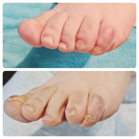 Soin des Ongles des Pieds